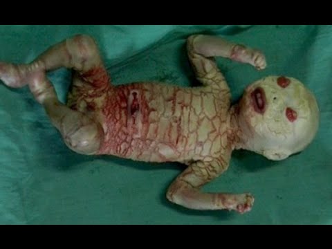Dünya Üzerindeki En Kötü 10 Genetik Mutasyon